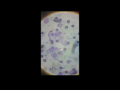 Лимфома под микроскопом