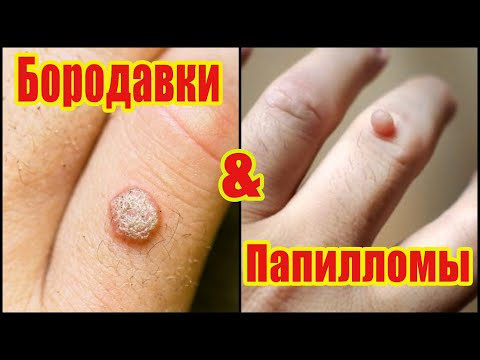 Что такое папилломы и бородавки? Как отличить папиллому от бородавки?