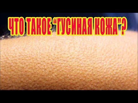 Что такое "гусиная кожа"? Механизм возникновения и функции "гусиной кожи".