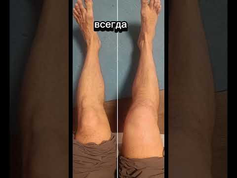 восстановление колена, начало #колено #реабилитация