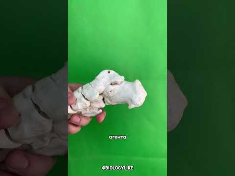 Что такое пяточная шпора?